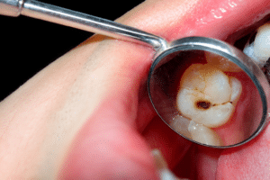 Dental Fillings in Milton: What to Expect