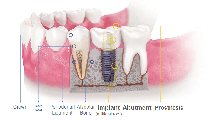 Dental Implant