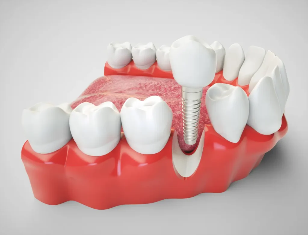 Dental Implant