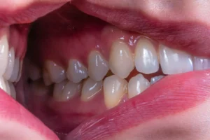 How Crooked Teeth Can Impact Your Life
