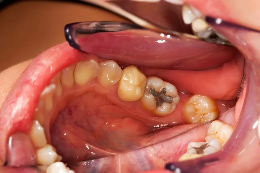 Old Amalgam Fillings