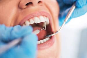 Oral Health Check‑Up & Clean in Milton