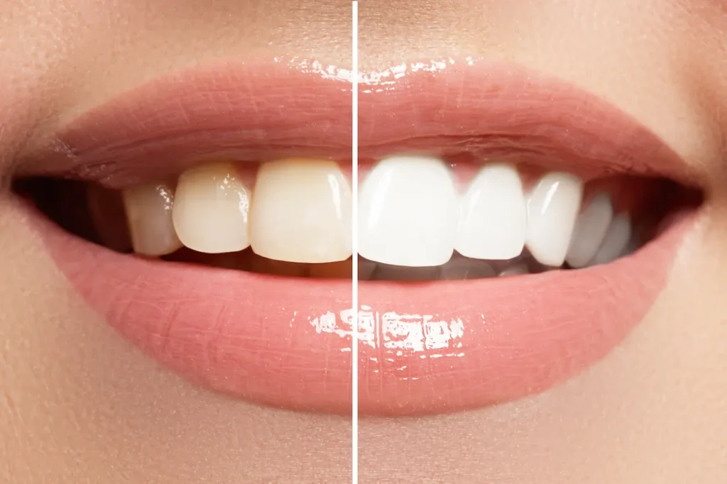 Teeth Whitening Solutions