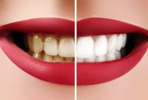 Tooth Discolouration