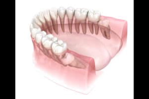 wisdom tooth removal