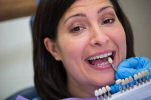 composite veneers