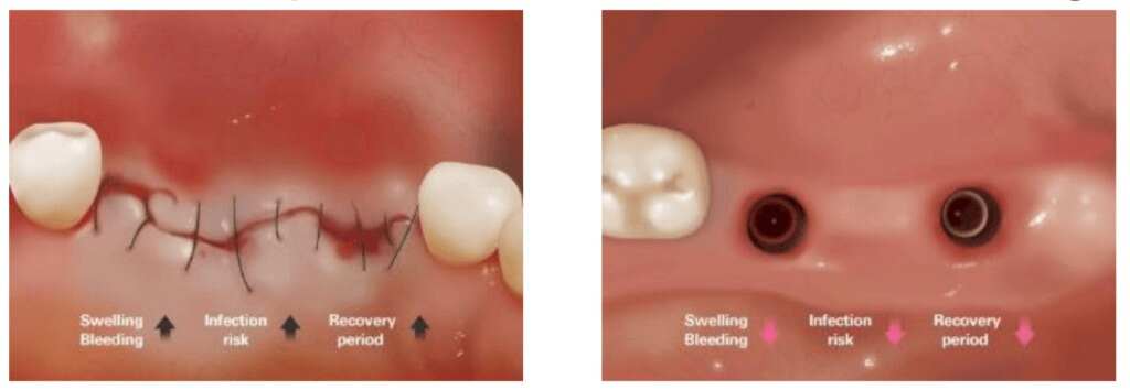 Recovery Time for Dental Implants