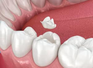 dental crown