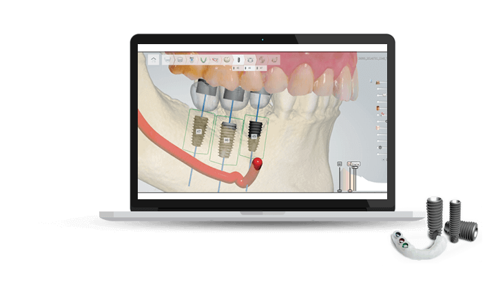 Dental Implants Work